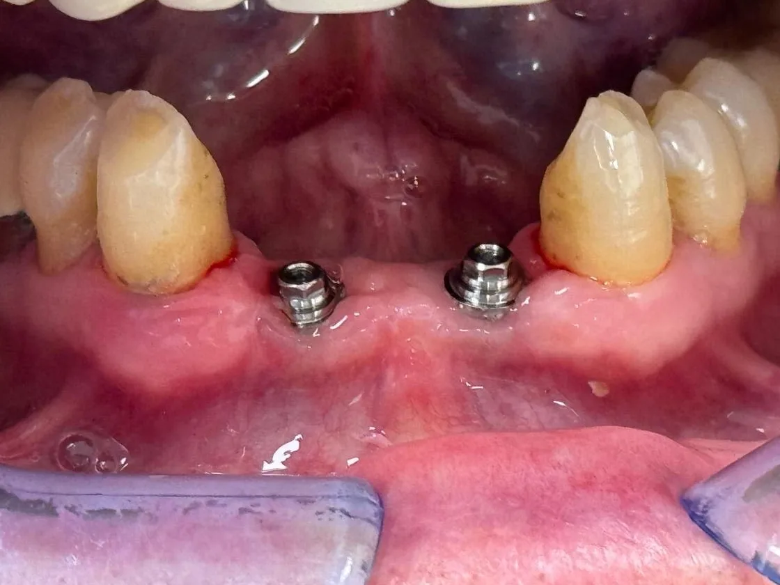 Arcata inferiore con i due impianti appena inseriti al posto degli incisivi