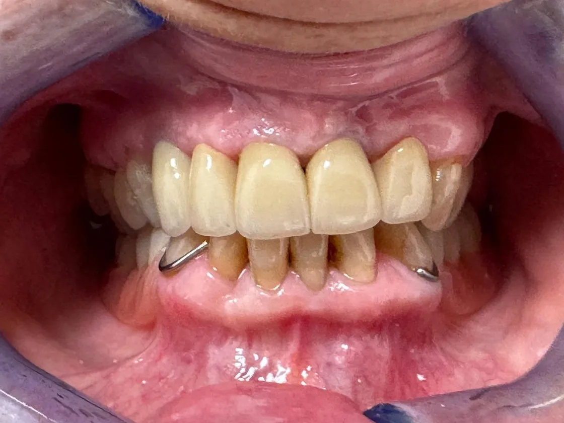 Denti anteriori superiori dopo il trattamento, con le nuove corone sugli impianti