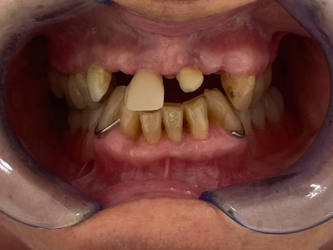 Denti anteriori superiori prima del trattamento, con spazi vuoti e corone da rifare